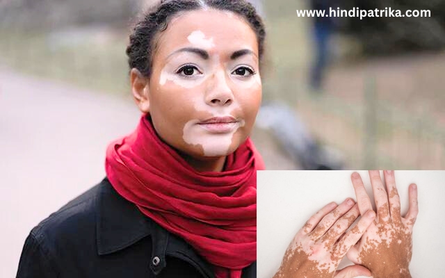 विटिलिगोः कारणों, लक्षणों, और उपचार विकल्पों को समझना